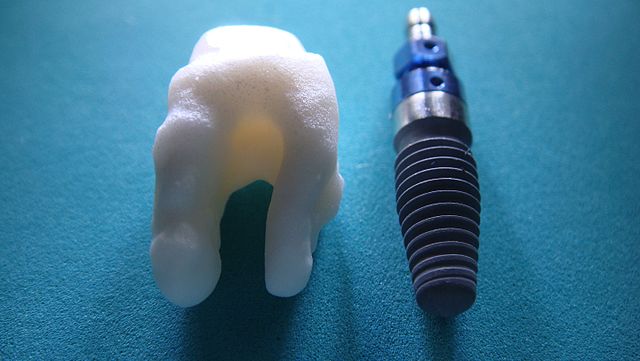 dental implants