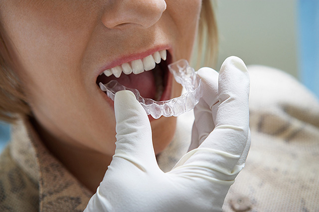 invisalign teeth