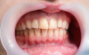 essential oils for gum health