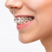 Fixing Overbite: Common Causes And Treatment Options
