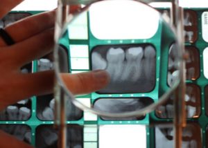 tooth resorption
