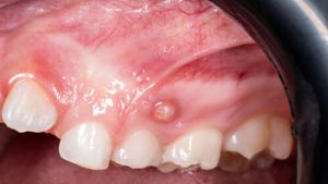 how to reverse periodontal disease naturally abscess